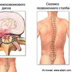Лечение болей в спине