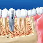 Имплантация зубов