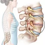 Как лечить грыжу поясничного отдела .
