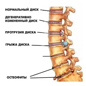 Диагностика и лечение грыжи диска,   грыжи Шморля