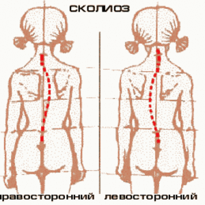 Лечение сколиоза