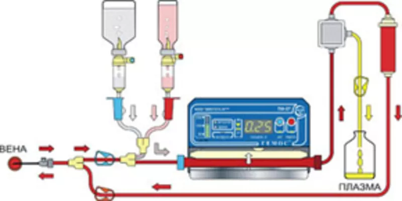 Проведение сеансов аппаратного фильтрационного плазмафереза