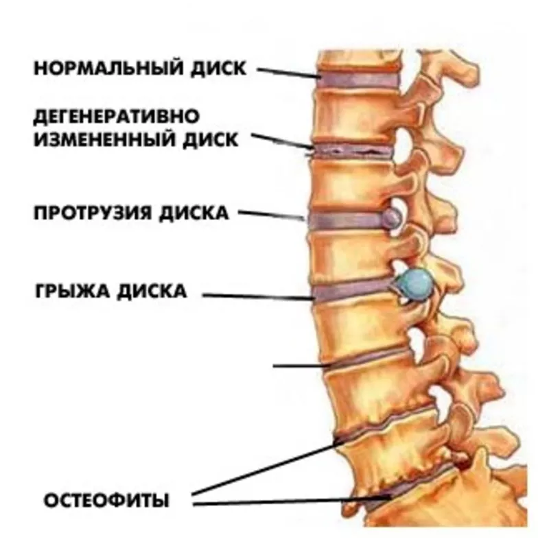 Диагностика и лечение грыжи диска,   грыжи Шморля