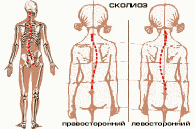 Лечение сколиоза