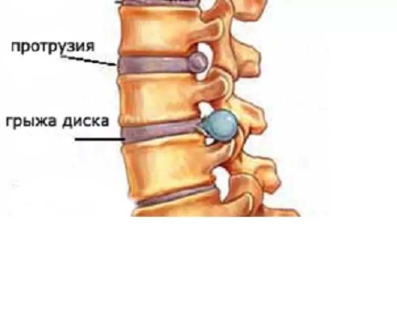 Исцеление от сколиоза,  лордоза,  кифоза,  межпозвоночных грыж  5