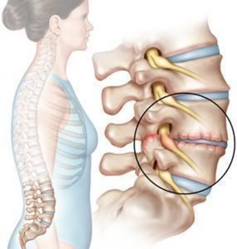 Как лечить грыжу поясничного отдела .