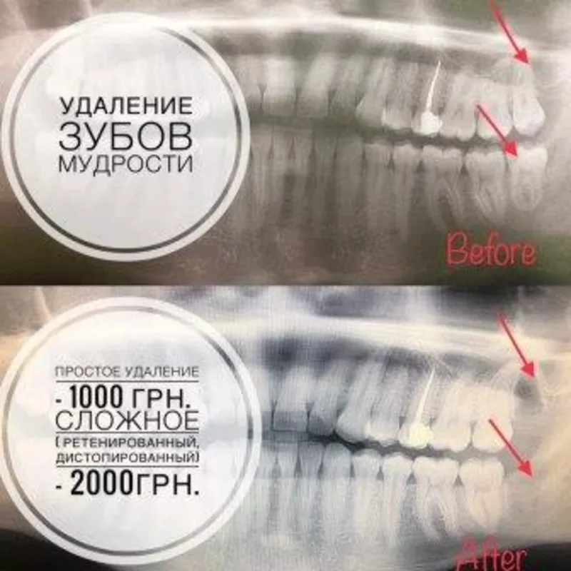 Удаление зубов мудрости